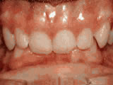 deep-overbite-before