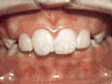 overbite-before